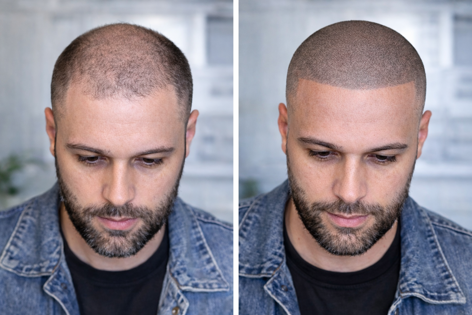 SMP before and after result