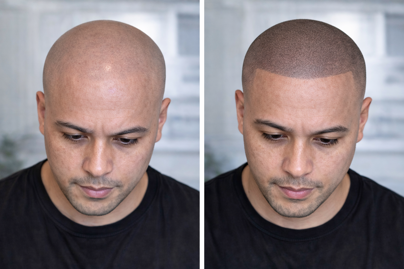 SMP before and after result