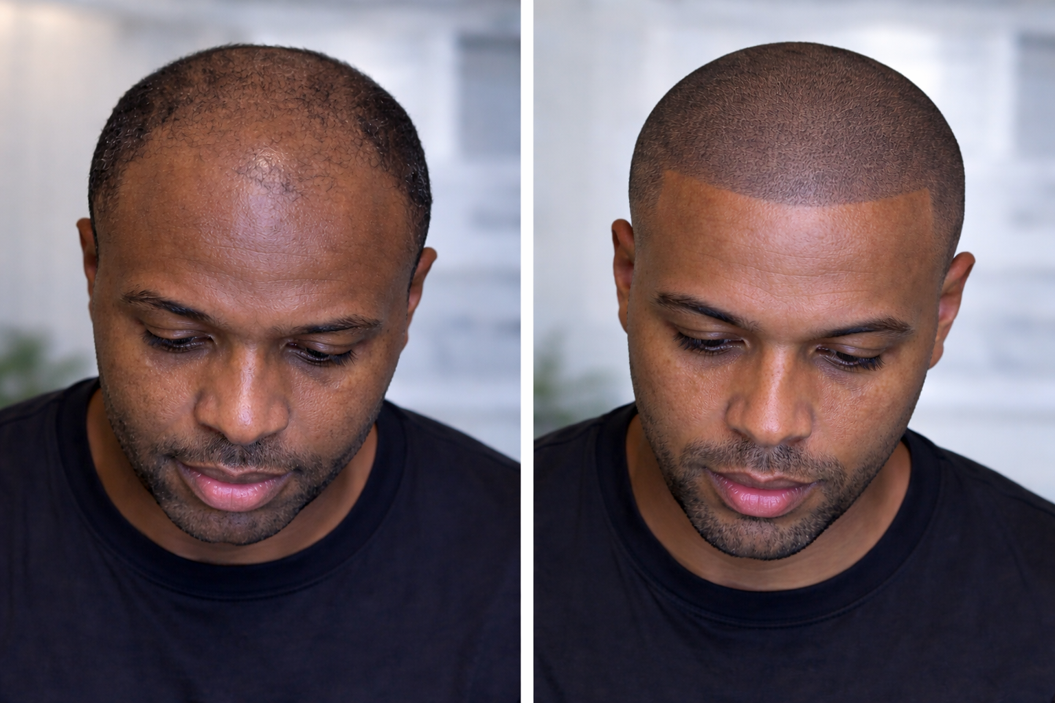 SMP before and after result