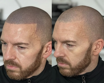 SMP before and after result