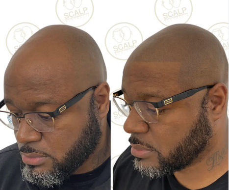 SMP before and after result