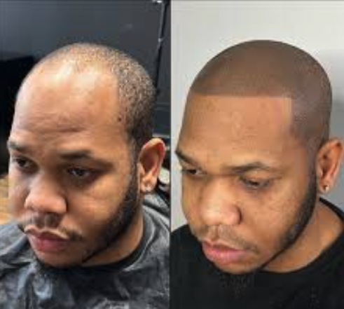 SMP before and after result